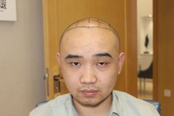 点击看大图 -大麦微针植发丨全国连锁