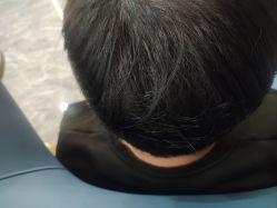 -碧莲盛·不剃发植发