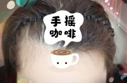 -大麦微针植发全国连锁