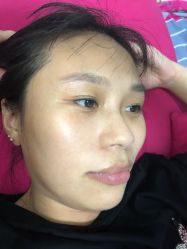 体验前-广州健丽·去眼袋医疗美容机构