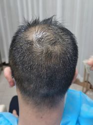 点击看大图 -新生植发·植养护一体