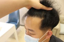 -大麦微针植发丨全国连锁