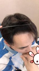 点击看大图 -大麦微针植发丨全国连锁