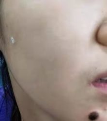 -北京美痣堂古方祛痣斑疣瘊