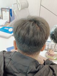 点击看大图 -碧莲盛·不剃发植发