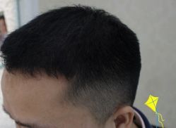 -大麦微针植发丨全国连锁