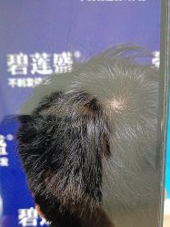 -碧莲盛·不剃发植发