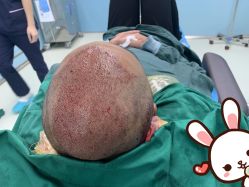 点击看大图 -大麦微针植发丨全国连锁