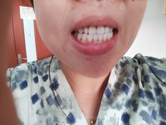 -赫尔森口腔·牙齿种植修复