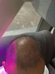 -碧莲盛·不剃发植发