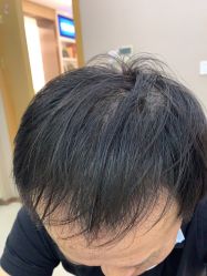 -大麦微针植发丨全国连锁