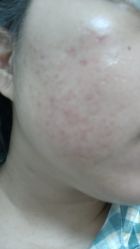 体验后-深圳米兰柏羽医疗美容医院