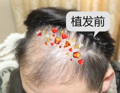 -大麦微针植发全国连锁