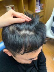 体验后-大麦微针植发全国连锁