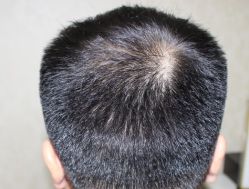 -大麦微针植发全国连锁