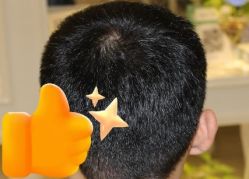 -大麦微针植发丨全国连锁