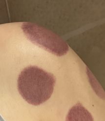 -苗塑堂减肥艾灸
