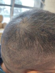 -碧莲盛·不剃发植发