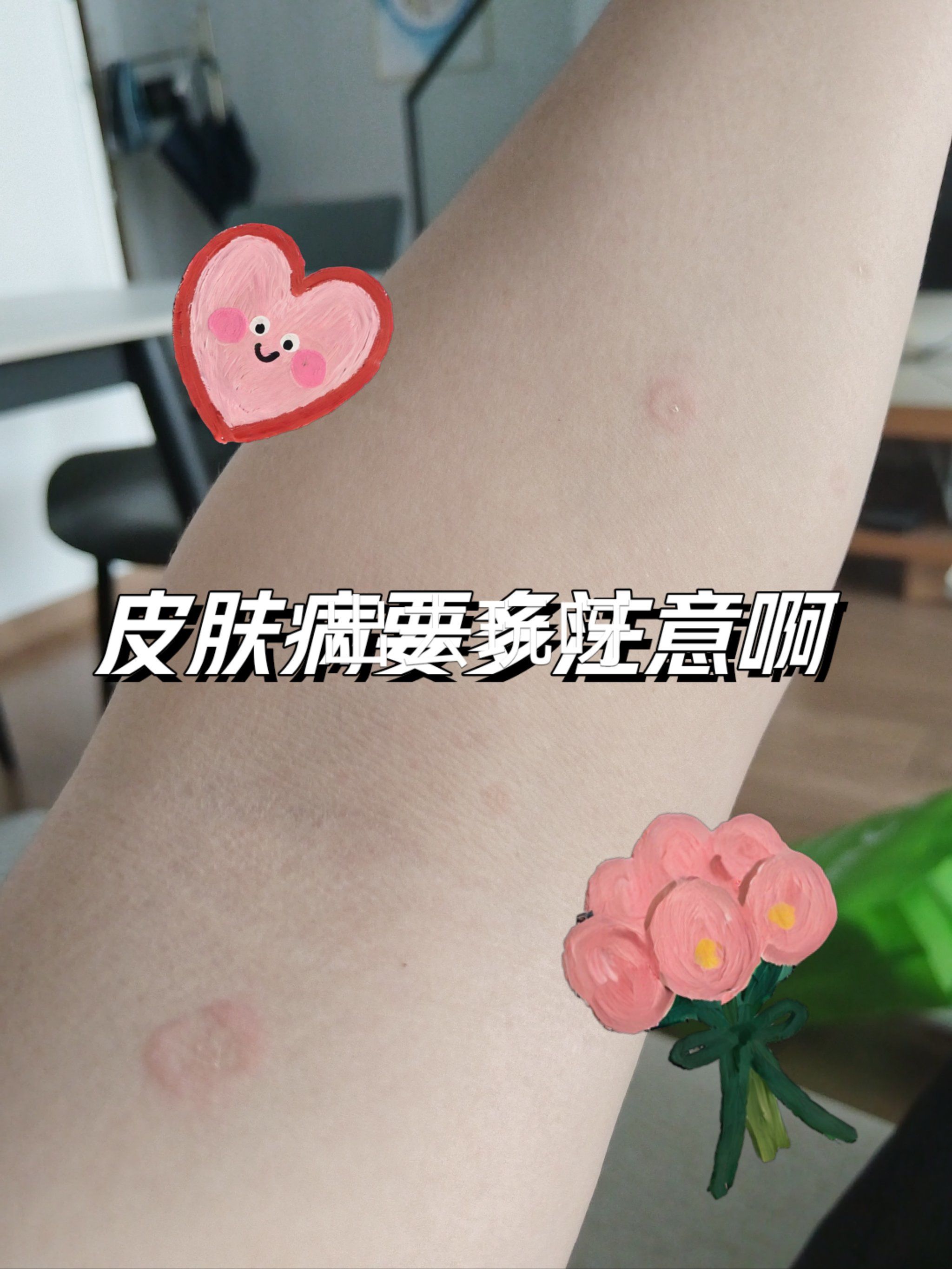 今天患者的病是皮癣,医生开了点药就好啦,大家在家里要注意了,夏天