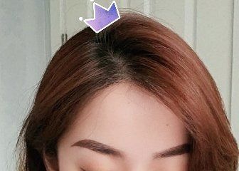 -大麦微针植发丨全国连锁