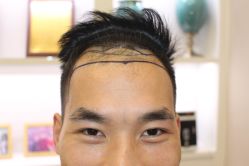 -大麦微针植发丨全国连锁