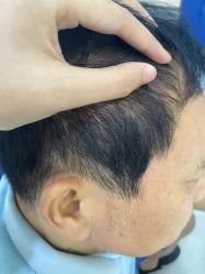 -大麦微针植发全国连锁