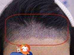 -大麦微针植发全国连锁