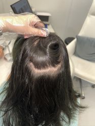 -大麦微针植发全国连锁