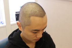 -大麦微针植发丨全国连锁