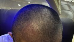 -碧莲盛·不剃发植发