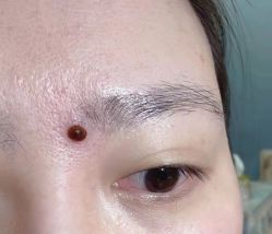 -北京美痣堂古方祛痣斑疣瘊