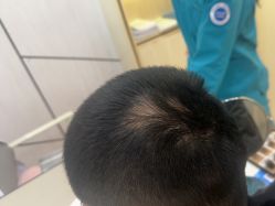 -碧莲盛·不剃发植发