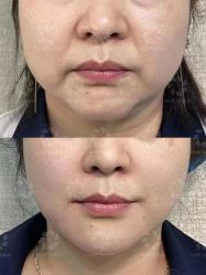 -苑苑vbeauty科技美容SPA