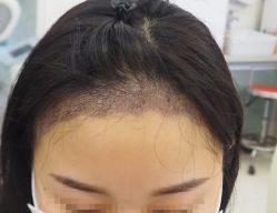 -大麦微针植发丨全国连锁