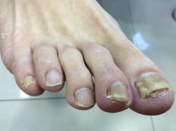 -德哥灰指甲脚气甲沟炎跖疣护理