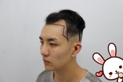 -大麦微针植发丨全国连锁