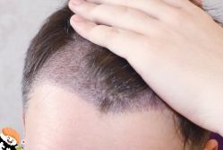 -大麦微针植发丨全国连锁