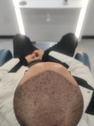 -大麦微针植发全国连锁