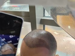 -碧莲盛·不剃发植发