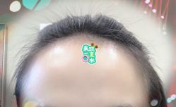 -大麦微针植发全国连锁