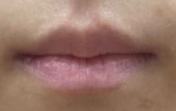 体验前-More摩尔医美の注射线雕光电中心