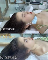 点击看大图 -OnFaer.纹眉半永久无创洗眉