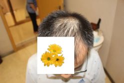 -大麦微针植发丨全国连锁