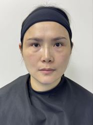 -广州健丽·去眼袋医疗美容机构