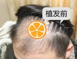 -大麦微针植发全国连锁