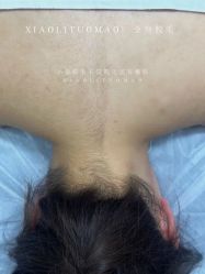 -小梨·OndaPro·专业脱毛连锁机构