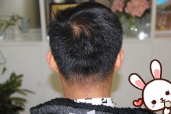 点击看大图 -大麦微针植发丨全国连锁