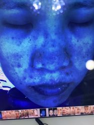 -瓷肌博士·祛痘科技美肤