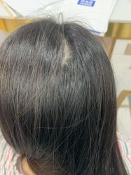 -碧莲盛不剃发植发
