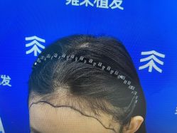 -雍禾植发全国连锁